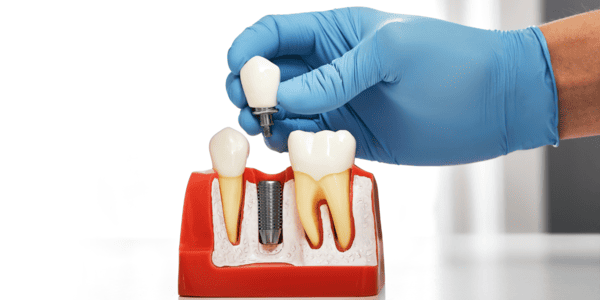 عيادة زراعة أسنان بالمهندسين