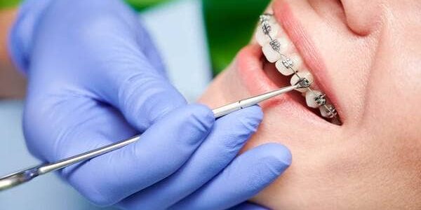 لماذا نحن افضل عيادة لتركيب تقويم الأسنان في المهندسين